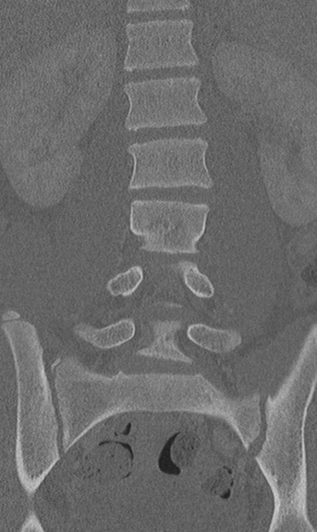 File:Chance fracture (Radiopaedia 40360-42912 Coronal bone window 32).png