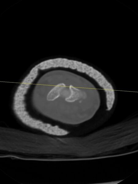 File:Chauffeur's (Hutchinson) fracture (Radiopaedia 58043-65079 Axial bone window 14).jpg