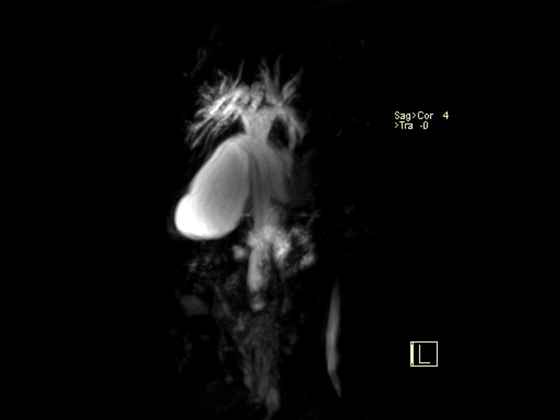 File:Choledocholithiasis causing intrahepatic biliary duct dilation (Radiopaedia 39908-42369 3D MRCP 3).jpg