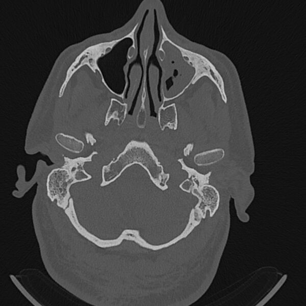 File:Cholesteatoma (Radiopaedia 68176-77673 Axial bone window 6).jpg