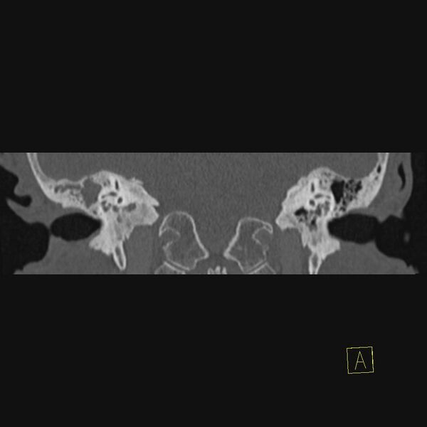 File:Cholesteatomatous chronic otitis (Radiopaedia 14993-14911 Coronal bone window 3).JPEG