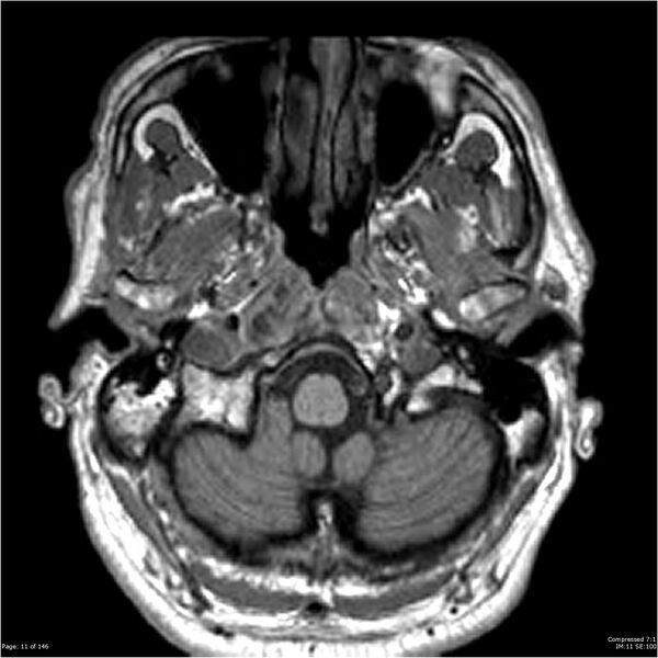 File:Chondrosarcoma of skull base- grade II (Radiopaedia 40948-43654 Axial T1 11).jpg