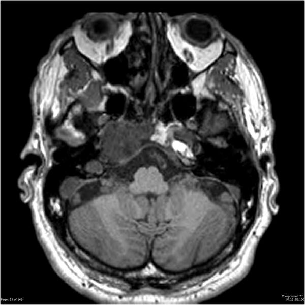 File:Chondrosarcoma of skull base- grade II (Radiopaedia 40948-43654 Axial T1 23).jpg