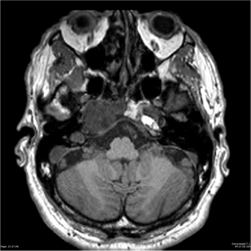 Chondrosarcoma of skull base- grade II (Radiopaedia 40948-43654 Axial T1 23).jpg