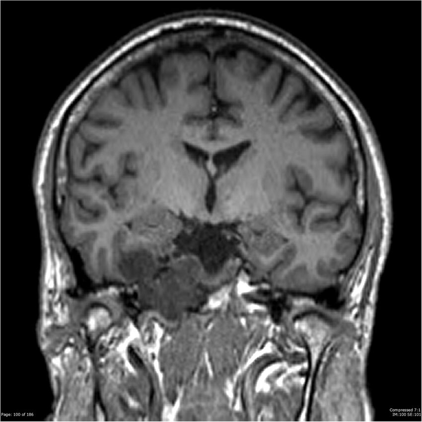 Chondrosarcoma of skull base- grade II (Radiopaedia 40948-43654 Coronal T1 21).jpg