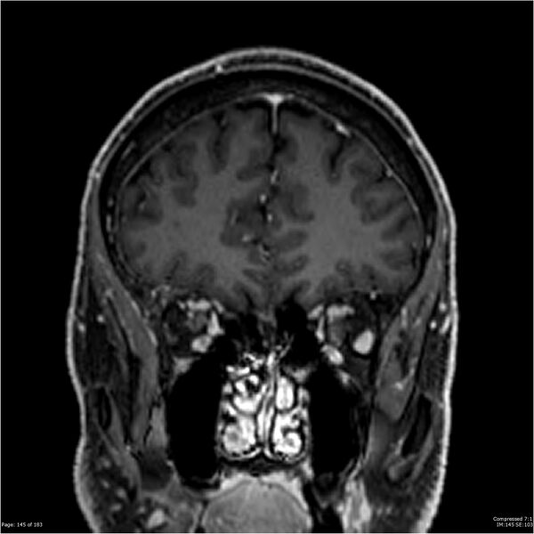 File:Chondrosarcoma of skull base- grade II (Radiopaedia 40948-43654 Coronal T1 C+ 56).jpg