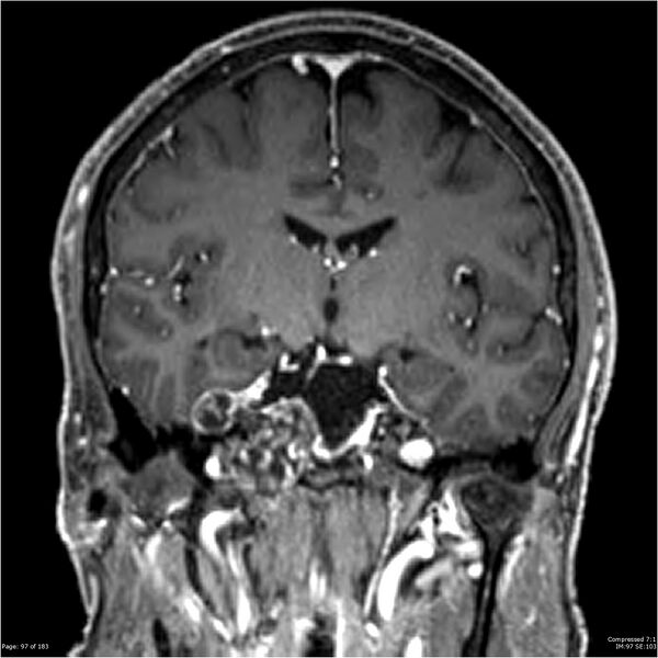 File:Chondrosarcoma of skull base- grade II (Radiopaedia 40948-43654 Coronal T1 C+ 8).jpg