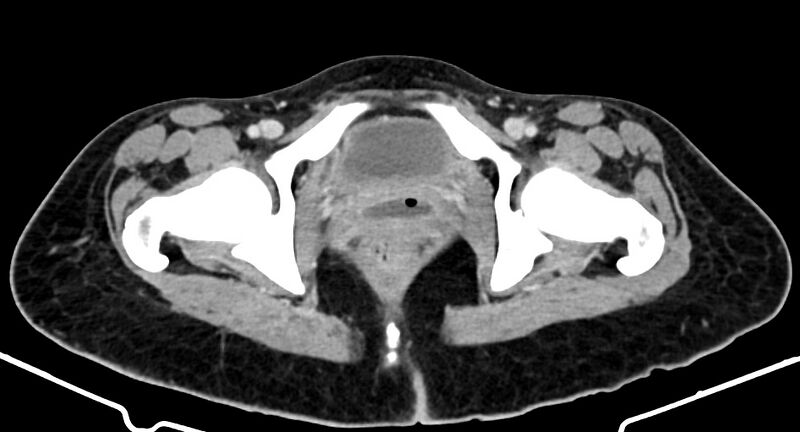 File:Choriocarcinoma liver metastases (Radiopaedia 74768-85766 A 200).jpg