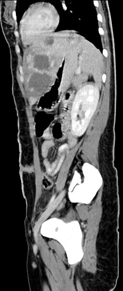File:Choriocarcinoma liver metastases (Radiopaedia 74768-85766 C 71).jpg