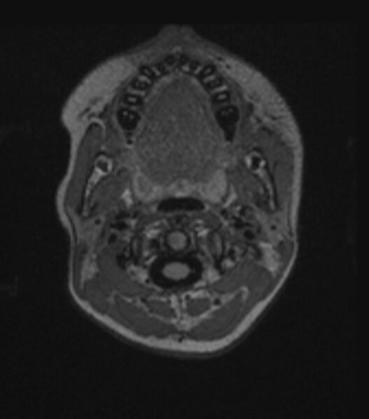 File:Choroid plexus carcinoma (Radiopaedia 91013-108553 Axial FLAIR C+ 51).jpg