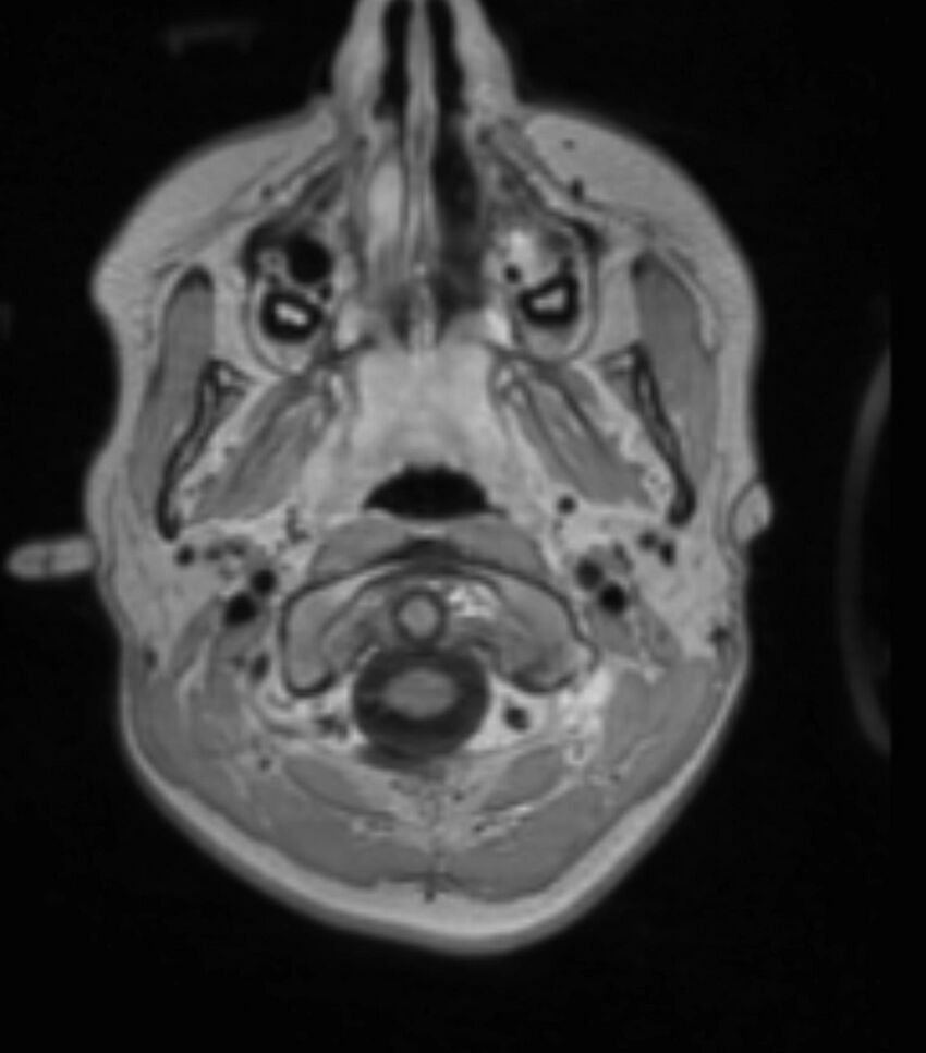 Choroid plexus carcinoma (Radiopaedia 91013-108553 Axial T1 C+ 64).jpg