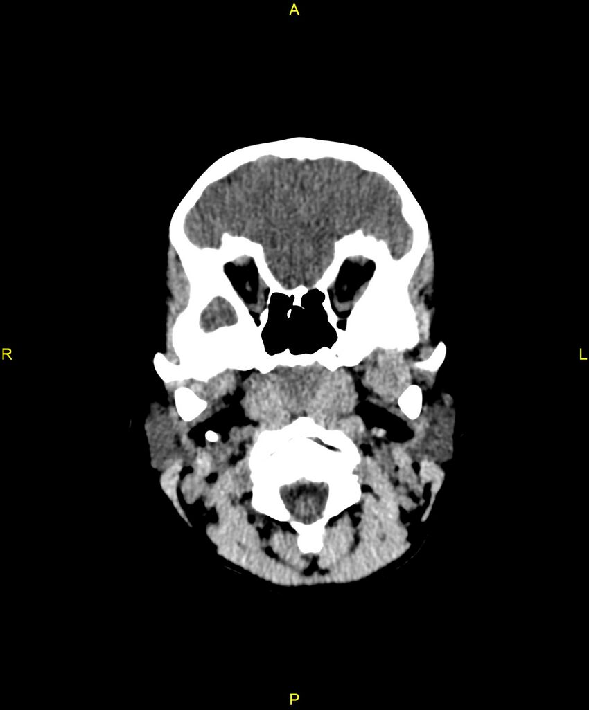 Choroidal fissure cyst (Radiopaedia 89481-106465 Axial non-contrast 19).jpg