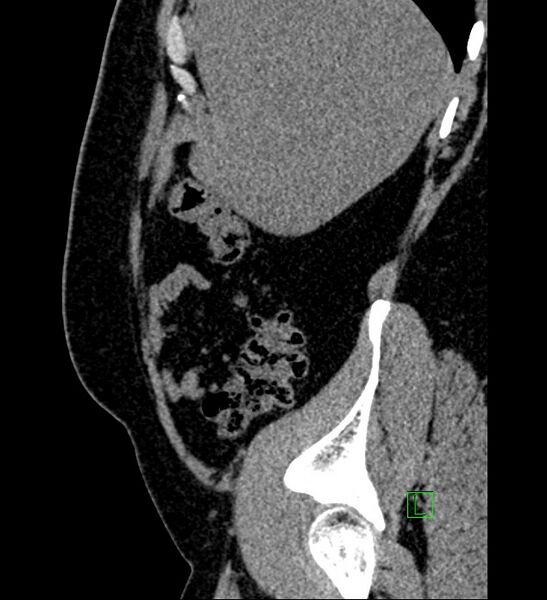 File:Chromophobe renal cell carcinoma (Radiopaedia 84286-99573 C 153).jpg