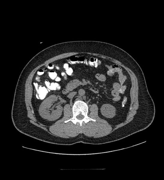 File:Chromophobe renal cell carcinoma (Radiopaedia 84337-99644 Axial non-contrast 46).jpg