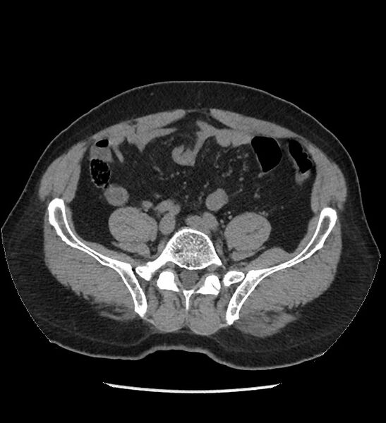 File:Chromophobe renal cell carcinoma (Radiopaedia 86879-103083 Axial non-contrast 85).jpg