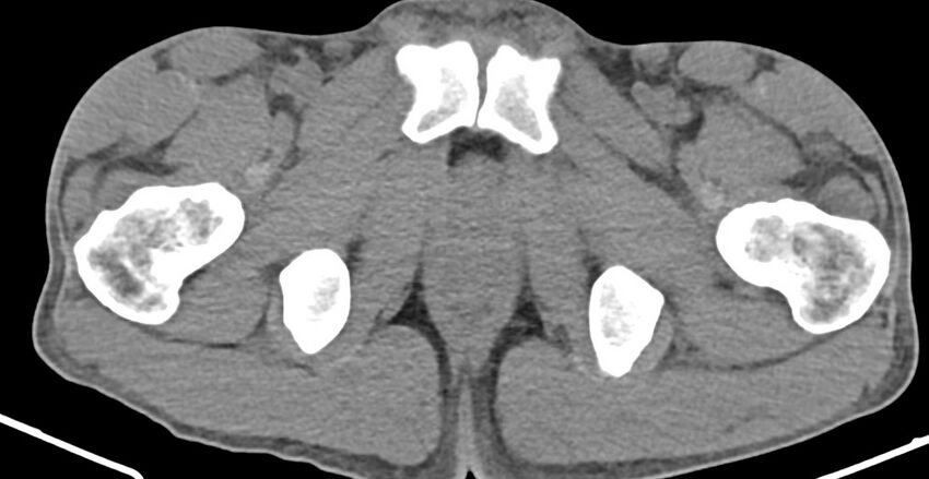 Chronic osteomyelitis (with sequestrum) (Radiopaedia 74813-85822 D 47).jpg