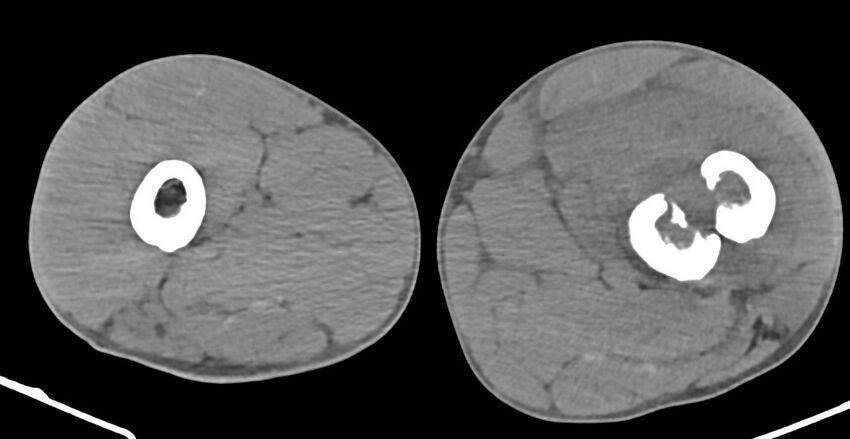 Chronic osteomyelitis (with sequestrum) (Radiopaedia 74813-85822 D 83).jpg