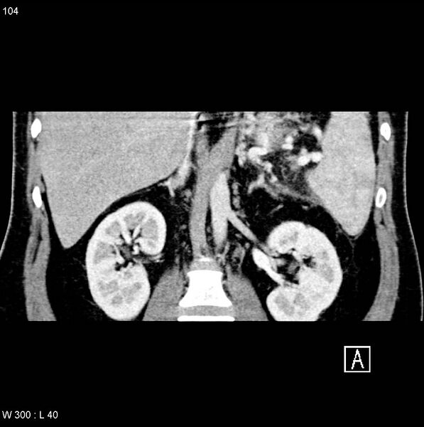 File:Chronic pancreatitis and pseudocysts (Radiopaedia 6724-7935 C 13).jpg