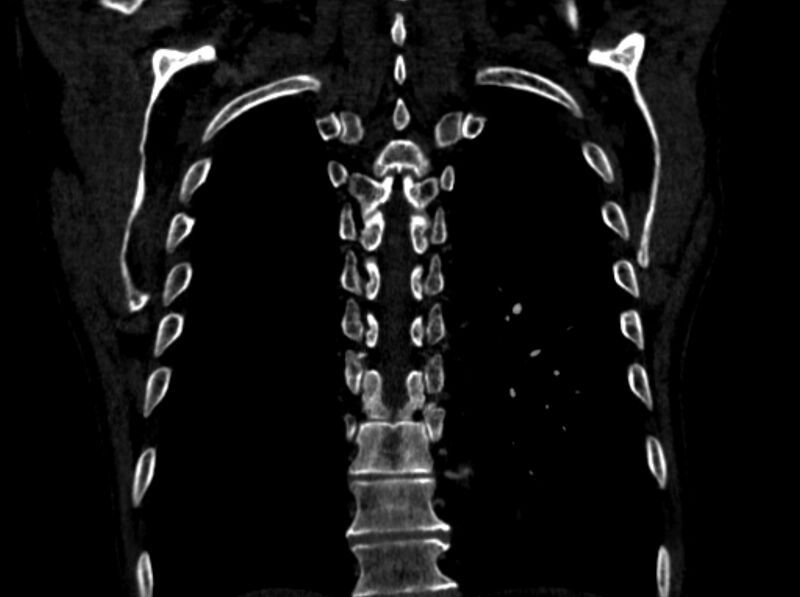 File:Chronic pulmonary embolism (Radiopaedia 91241-108843 A 93).jpg