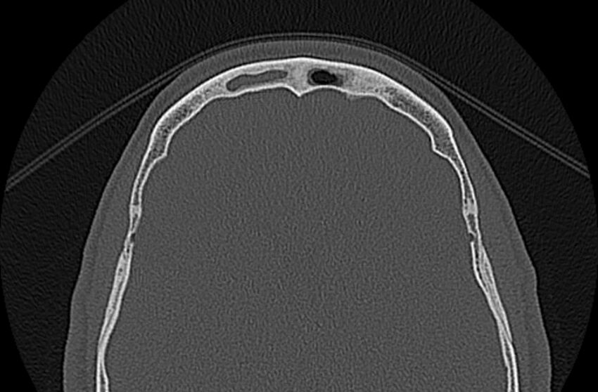 Chronic rhinosinusitis (Radiopaedia 65079-74075 Axial bone window 82).jpg
