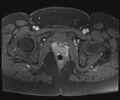 Class II Mullerian duct anomaly- unicornuate uterus with rudimentary horn and non-communicating cavity (Radiopaedia 39441-41755 Axial T1 fat sat 116).jpg