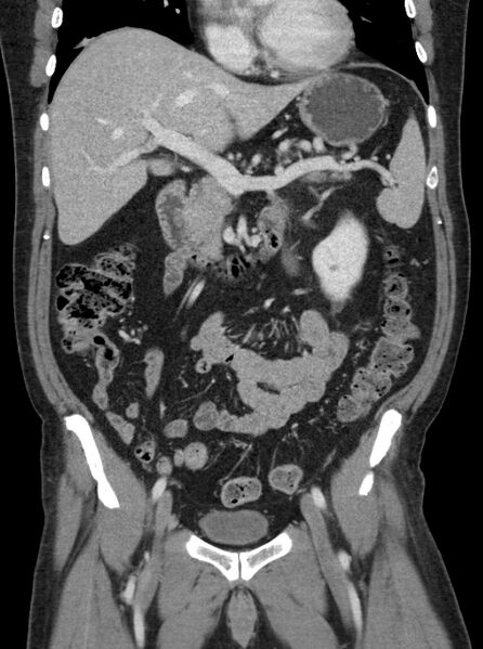 File:Clear cell renal cell carcinoma (Radiopaedia 61449-69393 F 7).jpg
