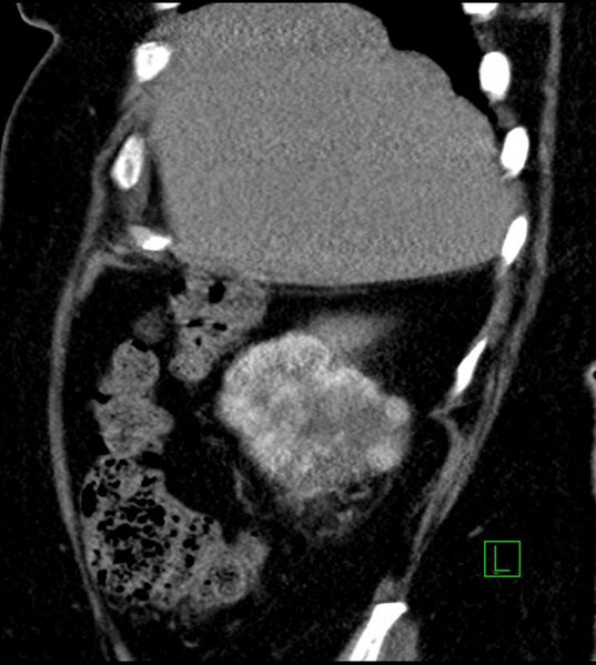 File:Clear cell renal cell carcinoma (Radiopaedia 85004-100537 D 52).jpg