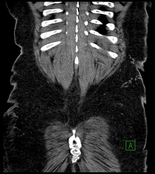 File:Closed-loop small bowel obstruction-internal hernia (Radiopaedia 78439-91096 Coronal non-contrast 91).jpg