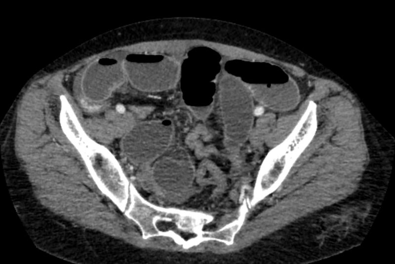 File:Closed loop small bowel obstruction (Radiopaedia 71211-81508 A 129).jpg