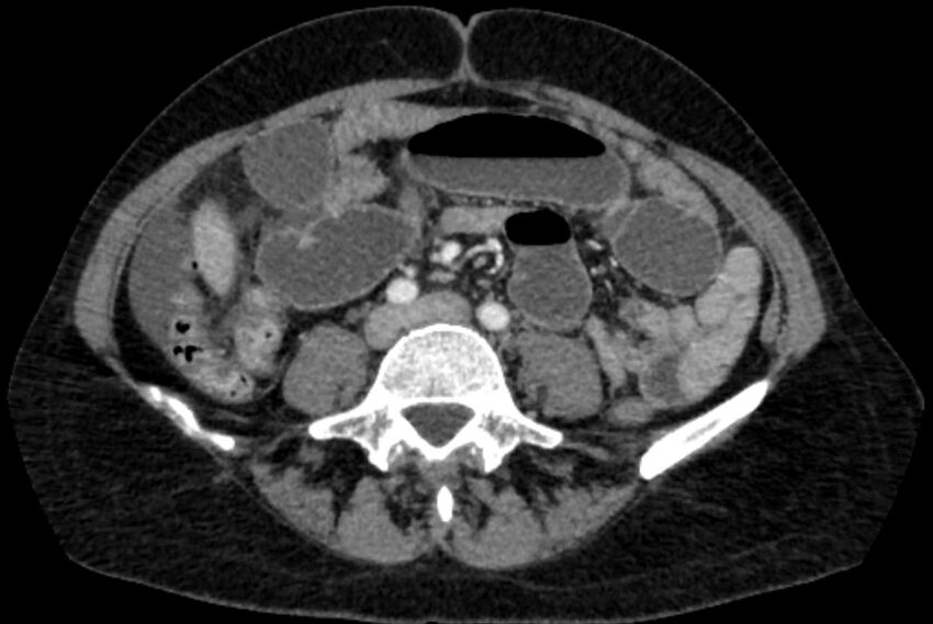 Closed loop small bowel obstruction (Radiopaedia 71211-81508 A 79).jpg