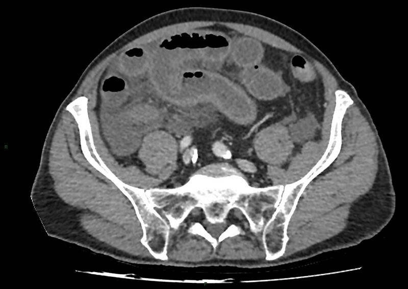 File:Closed loop small bowel obstruction with ischemia (Radiopaedia 84180-99456 A 87).jpg
