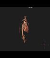 Coarctation of the aorta (Radiopaedia 43373-46729 3D reconstruction 32).jpg