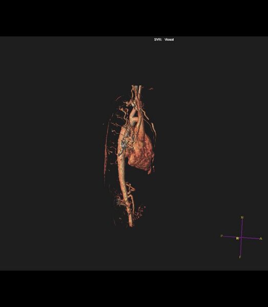 File:Coarctation of the aorta (Radiopaedia 43373-46729 3D reconstruction 32).jpg