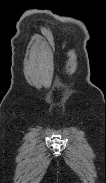 File:Coarctation of the aorta (Radiopaedia 74632-88521 B 252).jpg