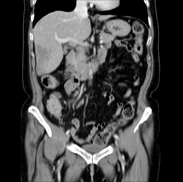 File:Colon carcinoma with hepatic metastases (Radiopaedia 29477-29961 B 19).jpg