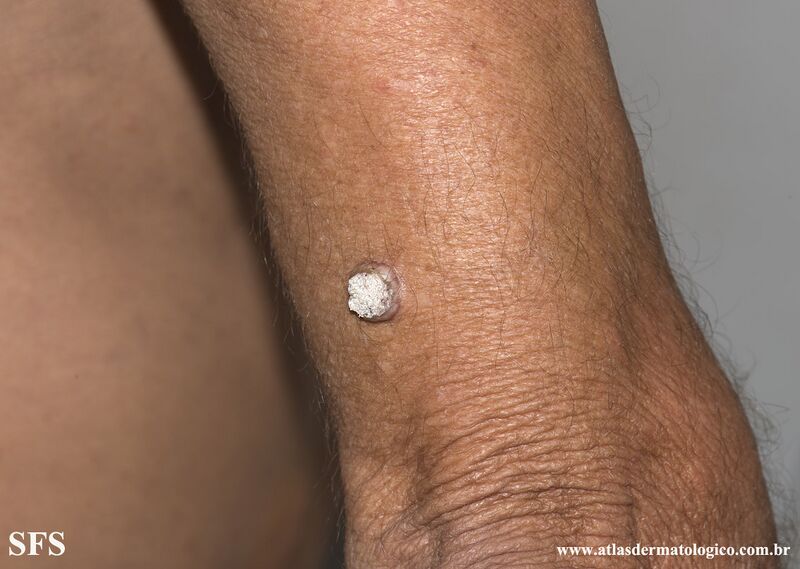File:Keratoacanthoma (Dermatology Atlas 68).jpg