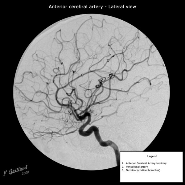 File:Lateral view of anterior cerebral artery (Radiopaedia 36123).jpg