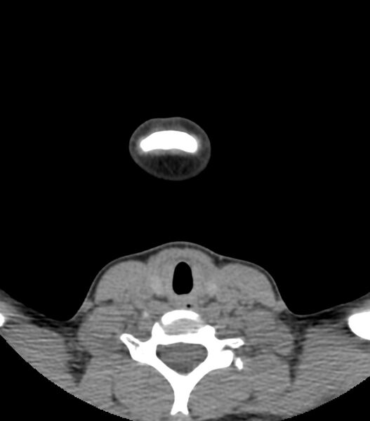 File:Nasoorbitoethmoid fracture (Radiopaedia 90044-107205 Axial non-contrast 11).jpg