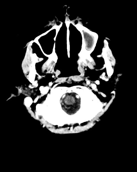 File:Nasopharyngeal carcinoma with cerebral abscess (Radiopaedia 43018-46275 Axial C+ delayed 6).png