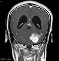 Neurofibromatosis type 2 - cranial and spinal involvement (Radiopaedia 5351-7111 Coronal T1 C+ 10).jpg