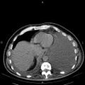 Non Hodgkin lymphoma in a patient with ankylosing spondylitis (Radiopaedia 84323-99621 Axial non-contrast 24).jpg