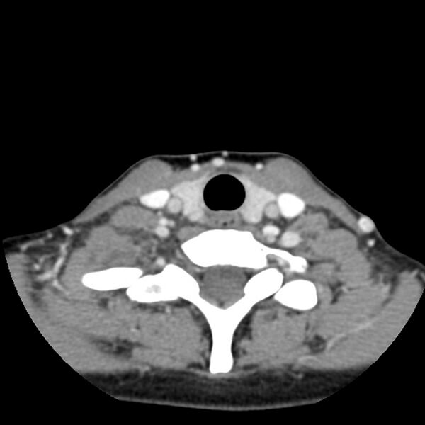 File:Normal CT of the neck (Radiopaedia 14575-14500 Axial C+ 53).jpg