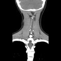 Normal CT of the neck (Radiopaedia 14575-14500 Coronal C+ 44).jpg