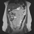 Normal liver MRI with Gadolinium (Radiopaedia 58913-66163 Coronal T2 15).jpg
