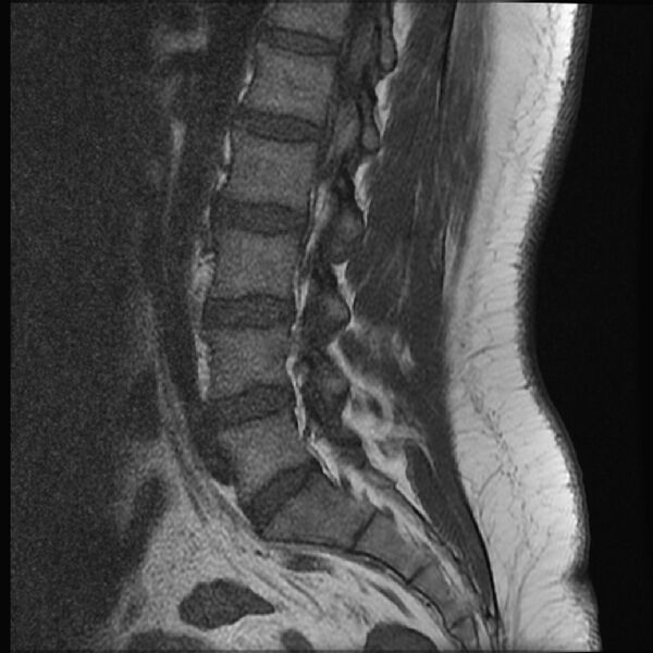 File:Normal lumbar spine MRI (Radiopaedia 43051-46311 Sagittal T1 8).jpg
