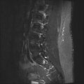Normal lumbar spine MRI (Radiopaedia 47857-52609 Sagittal STIR 5).jpg