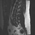 Normal lumbar spine MRI (Radiopaedia 47857-52609 Sagittal T2 15).jpg