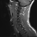 Normal trauma cervical spine (Radiopaedia 41017-43762 Sagittal T1 12).png