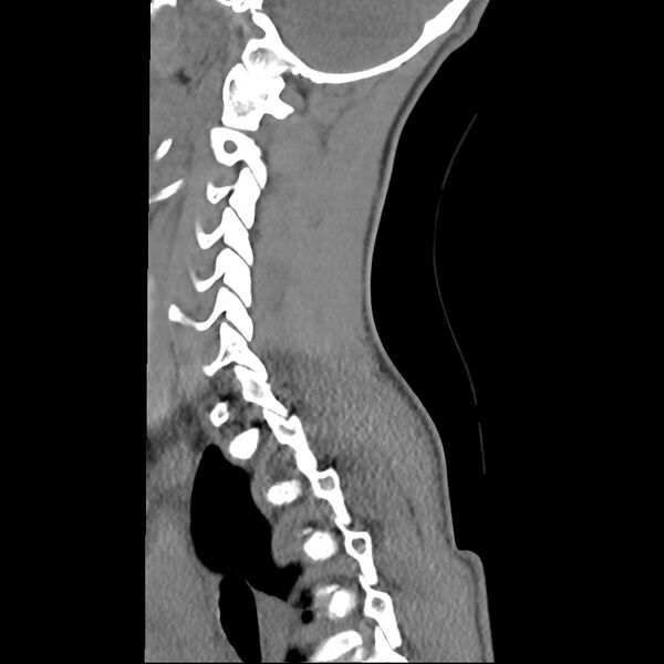 File:Normal trauma spine imaging (age 16) (Radiopaedia 45335-49358 C 9).jpg