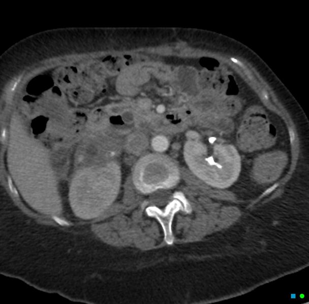 File:Obstructed infected horseshoe kidney (Radiopaedia 18116-17898 B 9).jpg